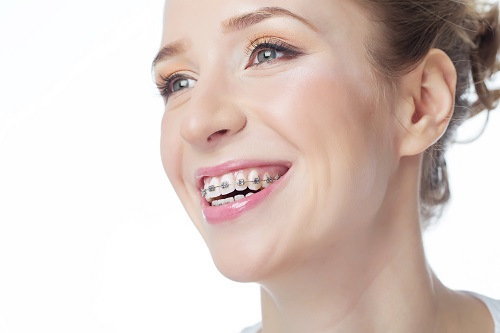 teenage girl with braces
