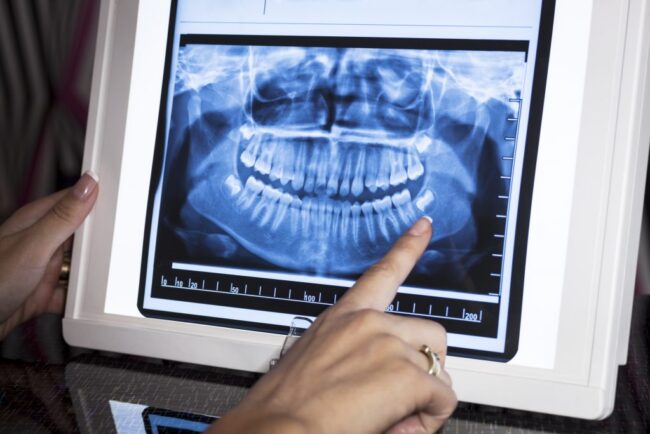 an x-ray of teeth