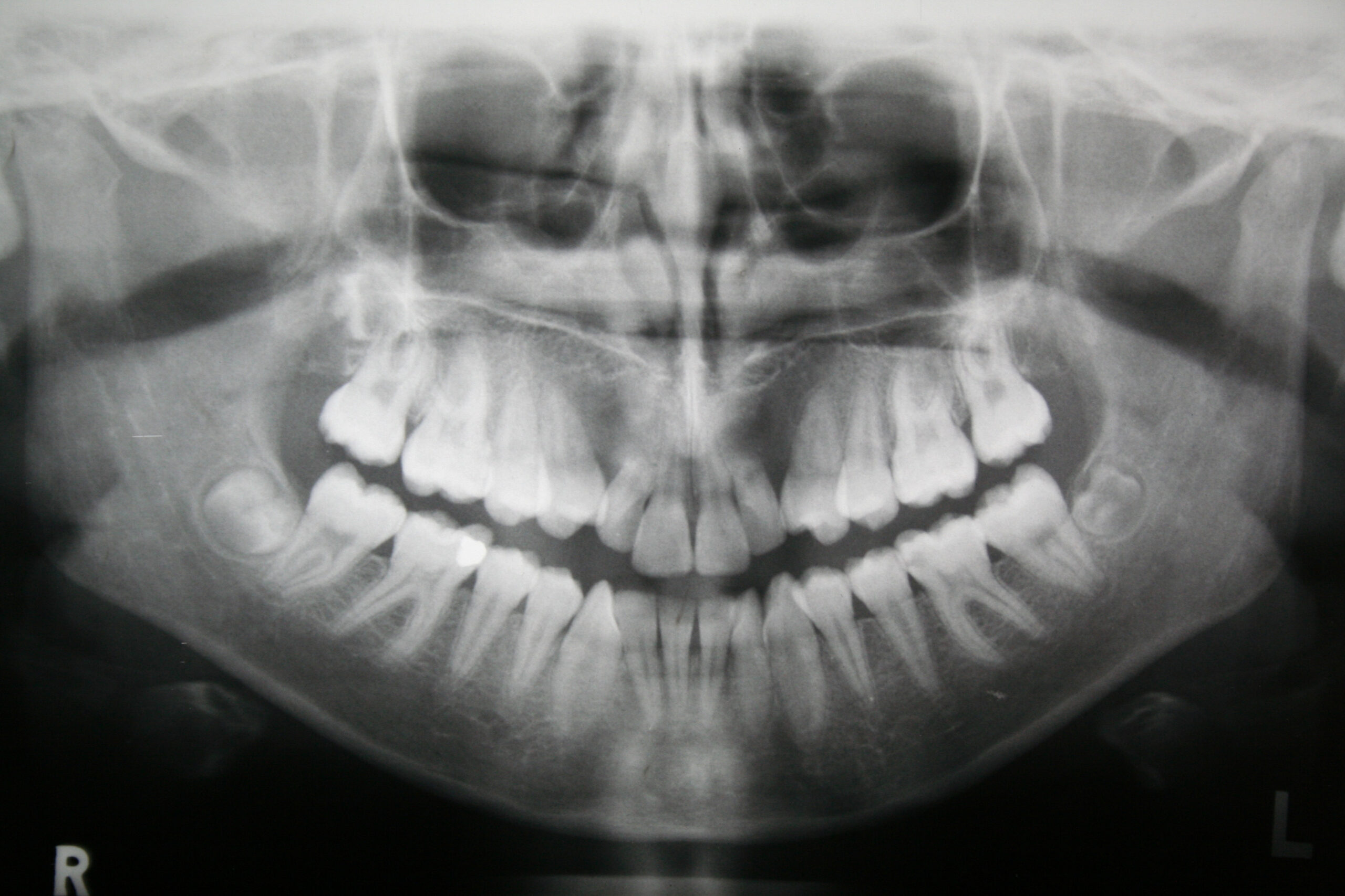 dental x-ray dental x-ray