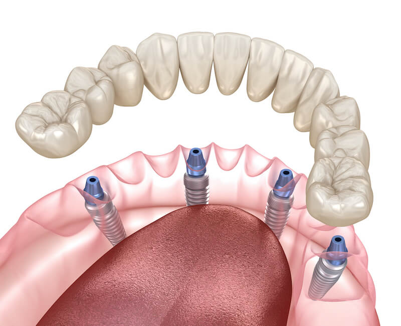Spring TX Dental Implants
