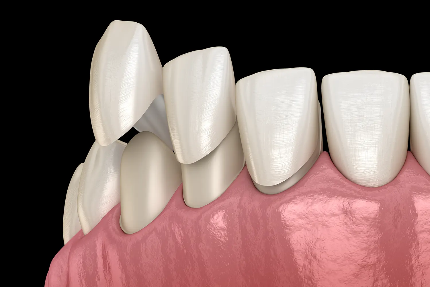 Can Veneers Fix Crooked Teeth?