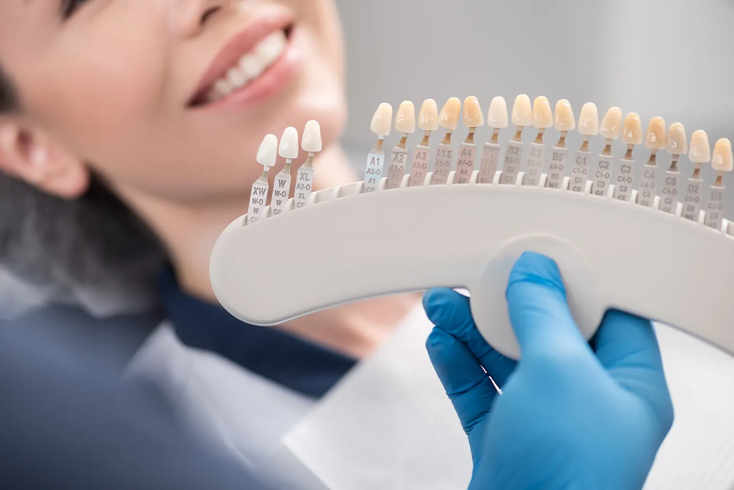 How Long Do Veneers Last on Front Teeth?