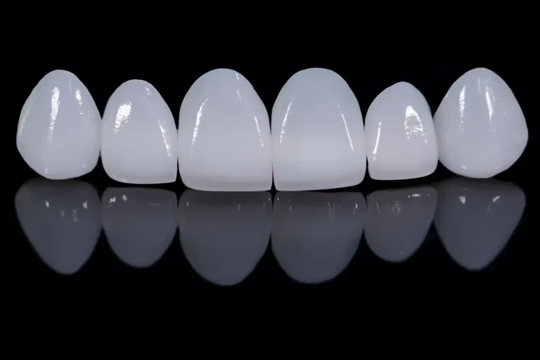 Do You Have To Brush Veneers?