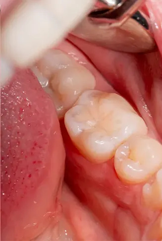 Dental Bonding